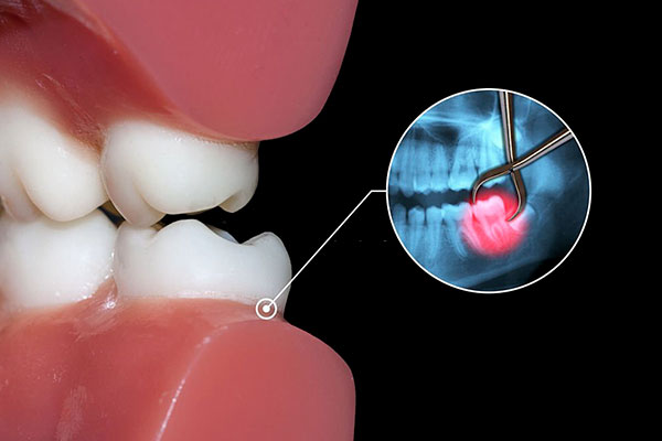 Extraction des dents de sagesse Saint-Omer - Dentiste Saint-Omer